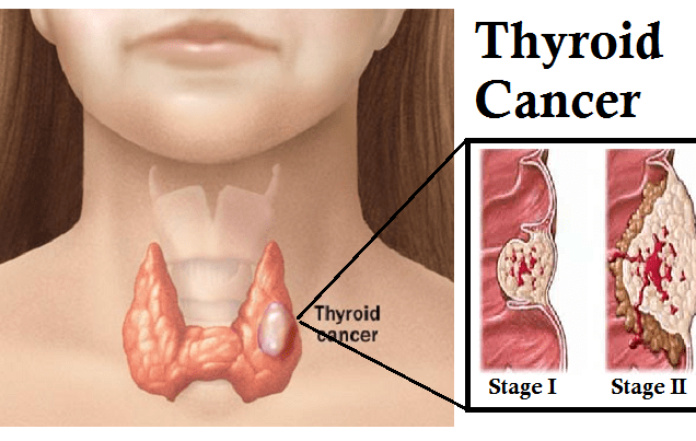 Thyroid-Cancer-Symptoms