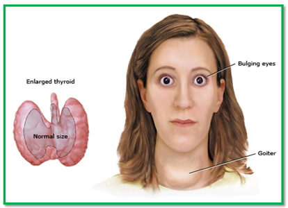Hyperthyroidism